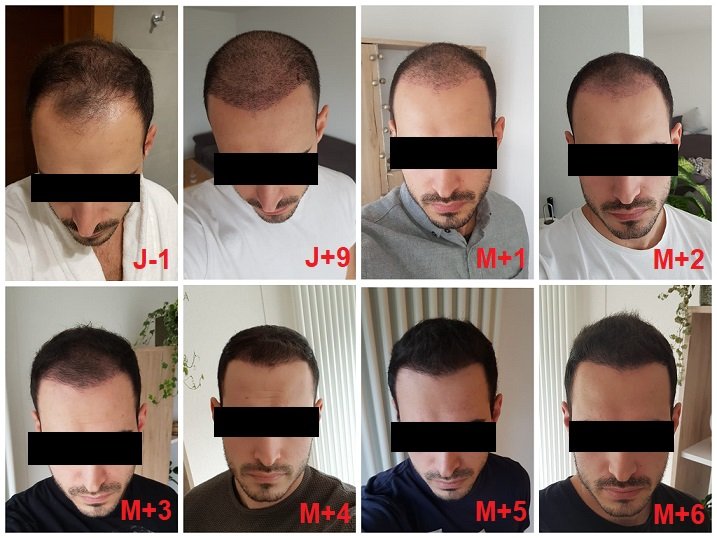 Hair transplant results after 6 months - 4100 grafts (full DHI) | Scrolller