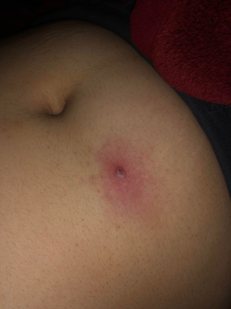 Should I get this checked out? I have had this ingrown hair for a couple  weeks now and it doesn't seem to go away. I don't know if it just turned  into
