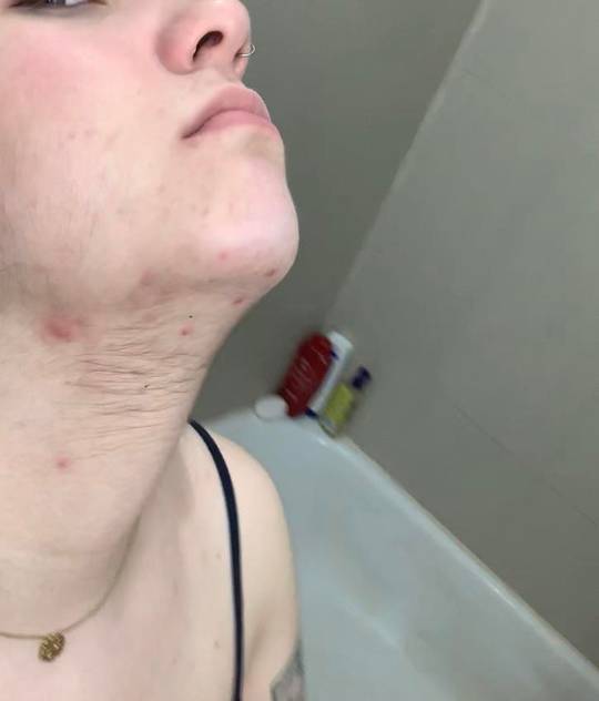 never had this before ~a year ago. got diagnosed with pcos 3 years ago, but  never had the facial/neck hair and acne until recently. it really makes me  feel embarrassed/sad. i don't